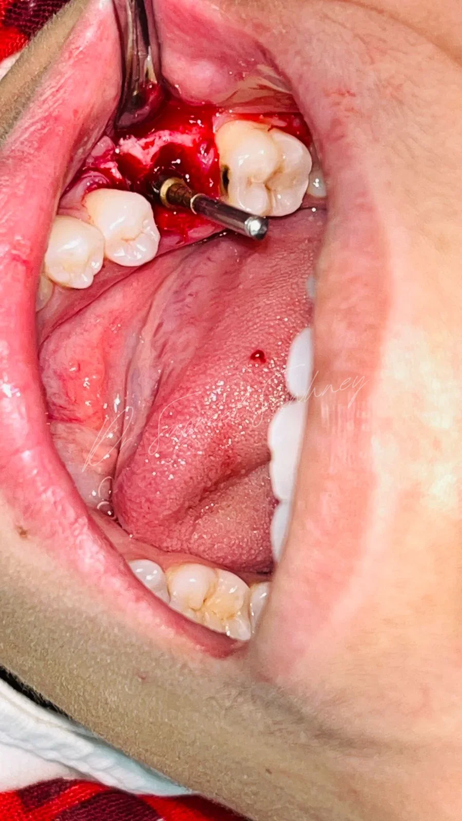 Intraoperative posterior mandibular view showing implant insertion with a hand driver